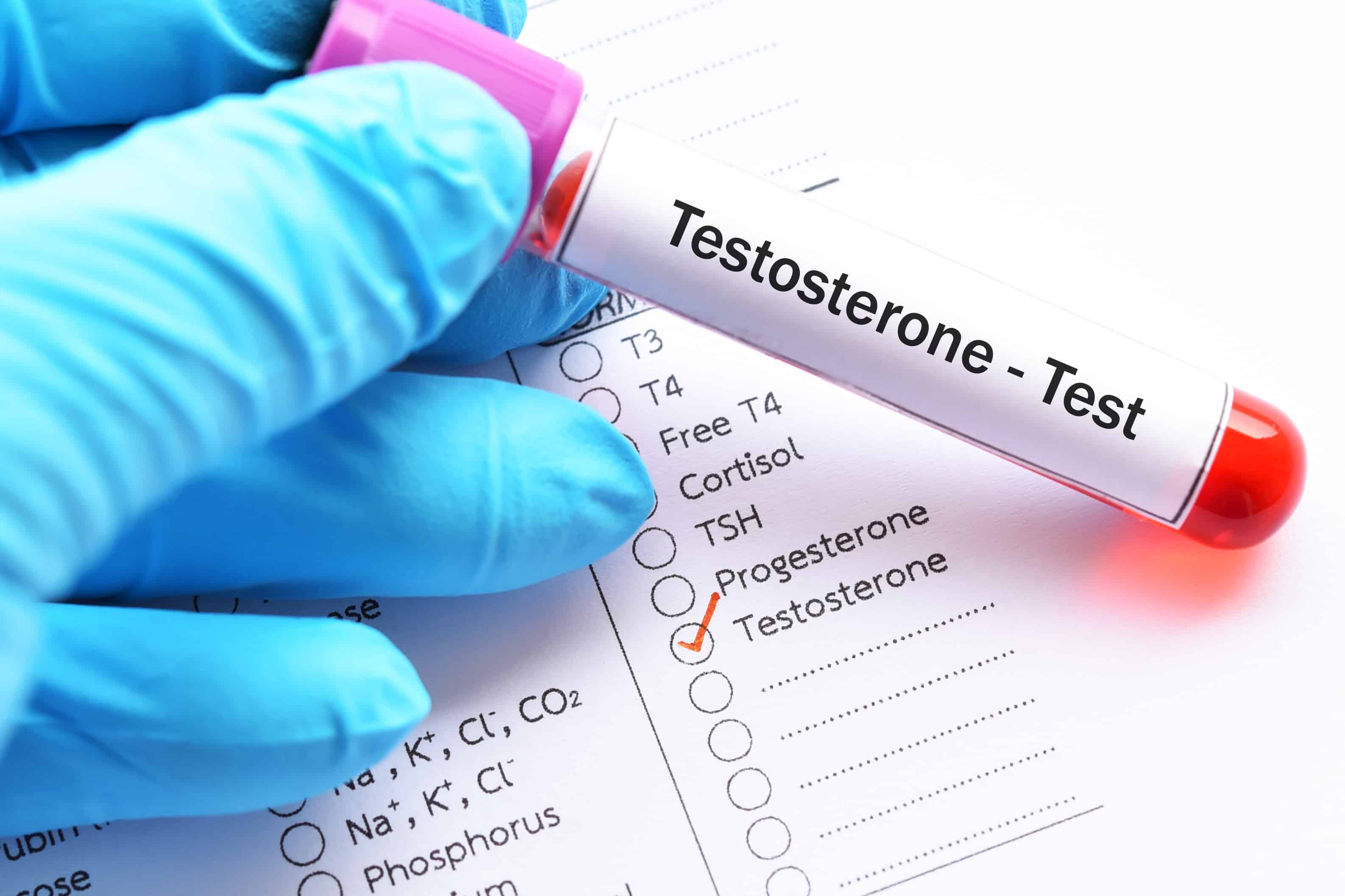 Testosterone blood sample in a labelled test tube