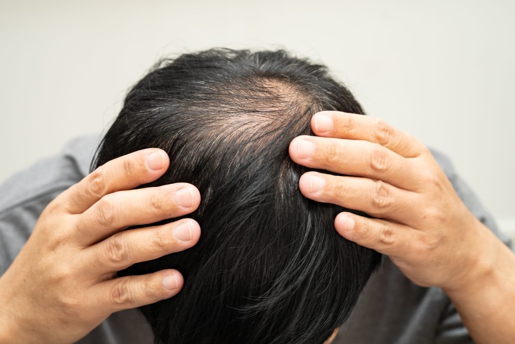 close up of man s scalp with thinning hair 2026 04 08 17 53 11 utc